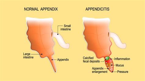 What age do people get appendix removed?